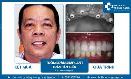 Trồng răng implant nha khoa sài gòn 