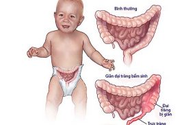 Phình đại tràng bẩm sinh ở trẻ em và cách điều trị