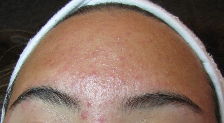 Triệu chứng của bệnh viêm nang lông ở mặt