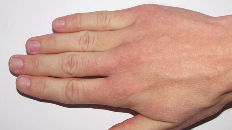 Ngón tay bị sưng đỏ, đau nhức là dấu hiệu bệnh gì?