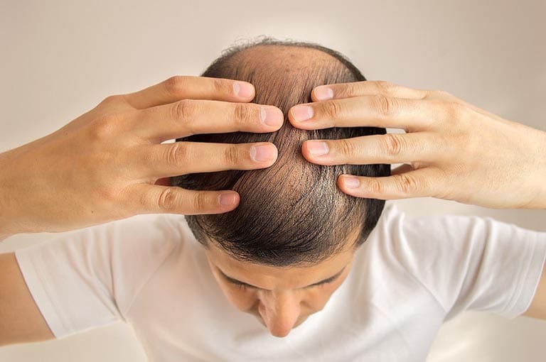 Rụng tóc ở nam giới: Những điều cần biết | Vinmec