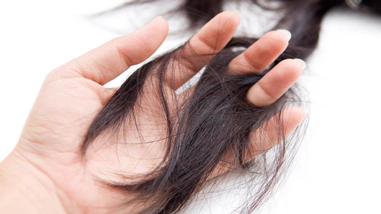 Tóc rụng nhiều và kéo dài có thể là dấu hiệu của nhiều bệnh nguy hiểm 