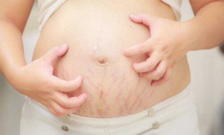 Có đến 70 - 80% các mẹ bầu gặp phải các vấn đề về da nhất là rạn da khi mang thai