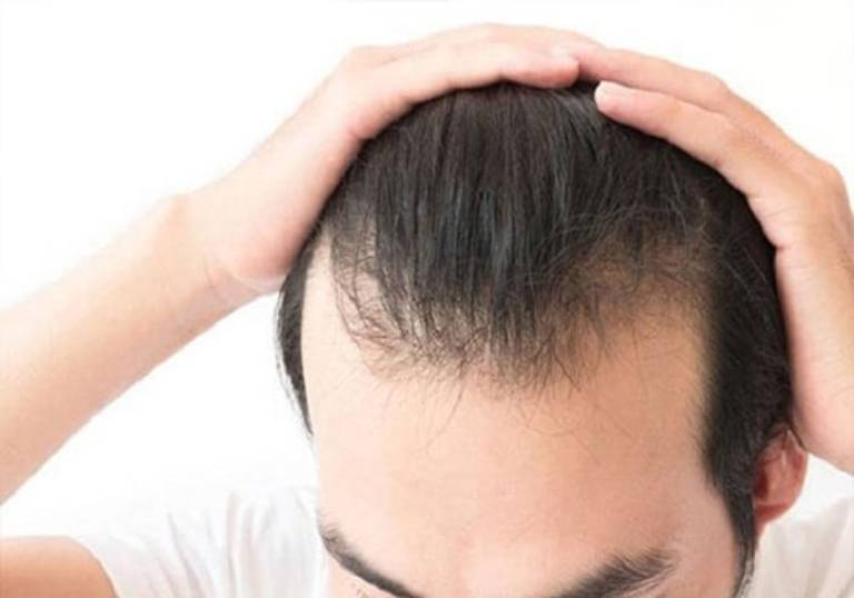 Rụng tóc ở nam giới Nguyên nhân và các mẹo kích thích mọc tóc