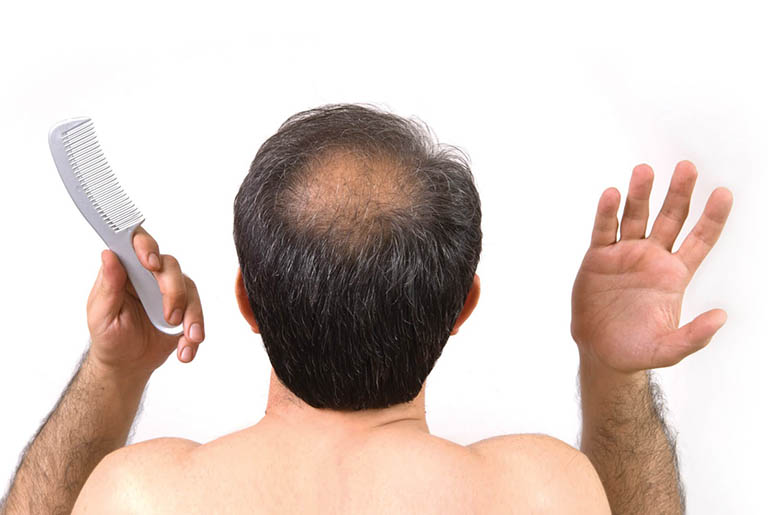 Rụng tóc ở nam giới Nguyên nhân và cách khắc phục hiệu quả