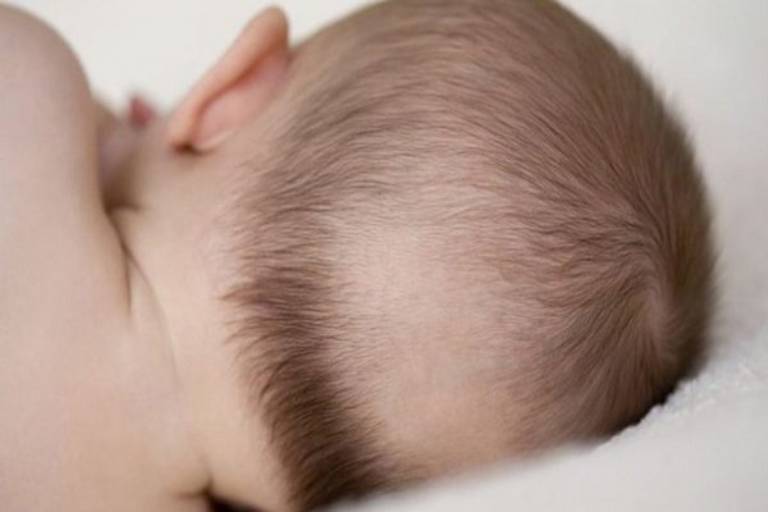 Rụng tóc vành khăn là kiểu rụng tóc thường gặp ở trẻ sơ sinh, có thể do thiếu chất hoặc do bé nằm ngửa nhiều
