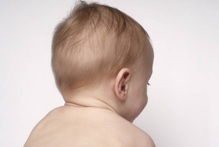 Rụng tóc ở trẻ sơ sinh là tình trạng thường gặp do nhiều nguyên nhân gây ra