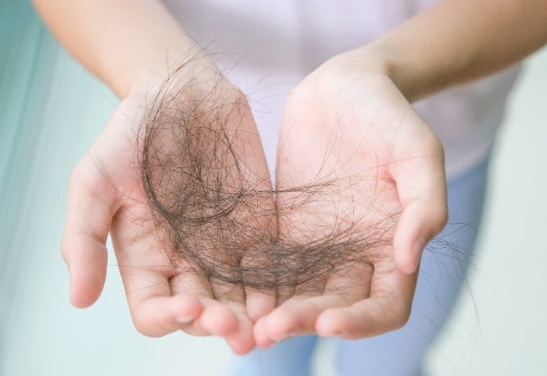 Rụng tóc sau khi sốt xuất huyết là tình trạng thường gặp vào khoảng 6 - 16 tuần sau bệnh