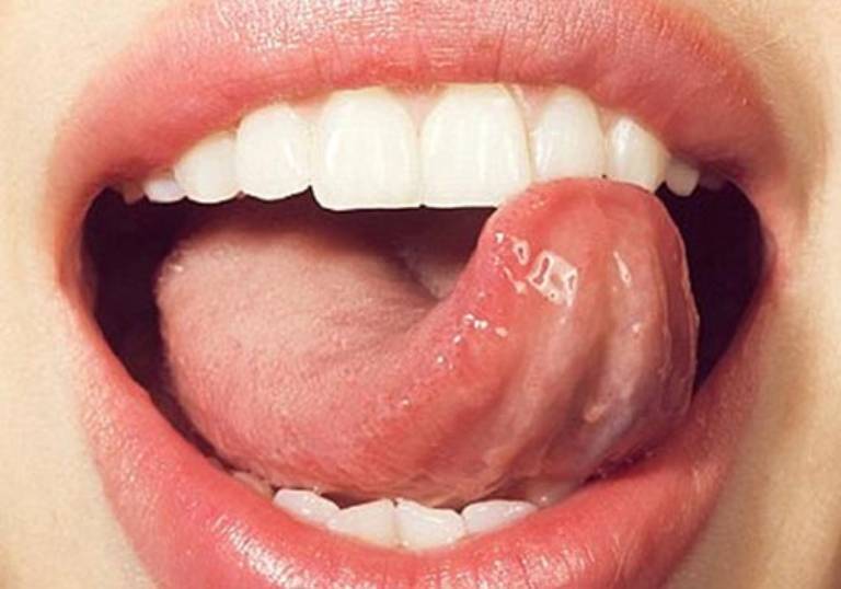 Nổi mụn thịt ở lưỡi là tình trạng không hiếm gặp, do nhiều nguyên nhân gây ra