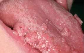 Tình trạng nổi mụn thịt ở lưỡi thường liên quan đến bệnh sùi mào gà ở lưỡi và thường bị nhầm lẫn với bệnh nhiệt miệng