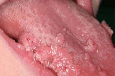Tình trạng nổi mụn thịt ở lưỡi thường liên quan đến bệnh sùi mào gà ở lưỡi và thường bị nhầm lẫn với bệnh nhiệt miệng