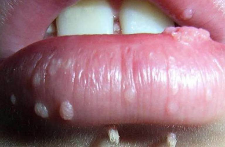 Nổi mụn thịt ở miệng có thể là do nhiễm virus u nhú HPV, một loại virus có thể lây truyền qua đường tình dục