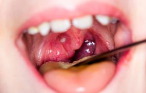 Nổi mụn thịt trong miệng không đơn thuần là do nhiệt miệng, nấm miệng mà có thể do nhiều nguyên nhân gây ra