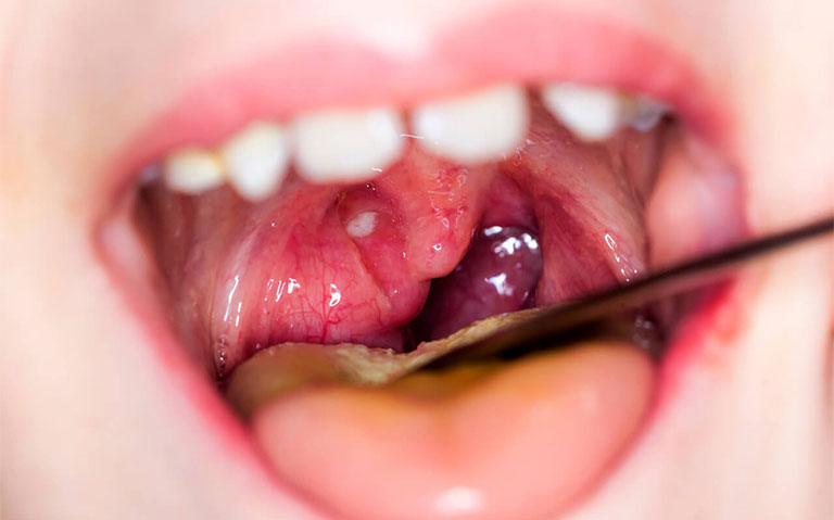 Nổi mụn thịt trong miệng không đơn thuần là do nhiệt miệng, nấm miệng mà có thể do nhiều nguyên nhân gây ra