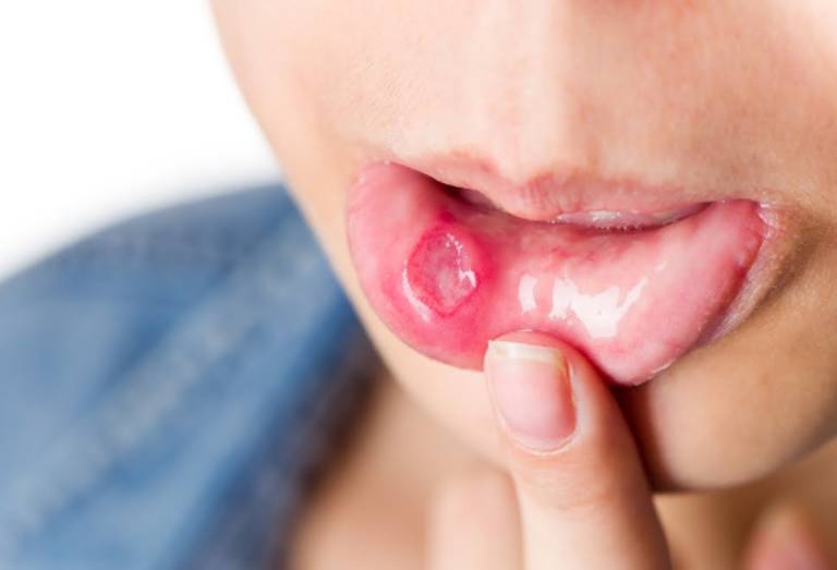 Tình trạng hay bị nhiệt miệng xuất phát từ nhiều nguyên nhân, thường do chế độ ăn uống, rối loạn nội tiết, suy giảm chức năng gan...
