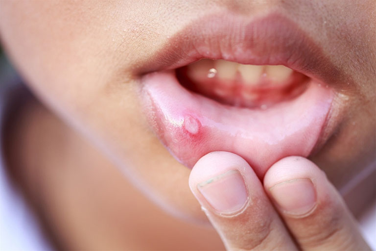 Các thông tin cần biết về bệnh nhiệt miệng và cách điều trị