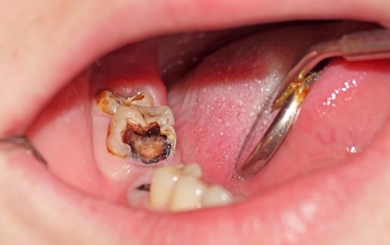 vì sao sâu răng hàm gây đau nhức