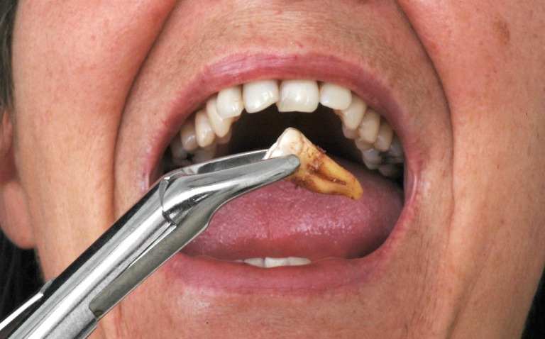 điều trị sâu răng hàm