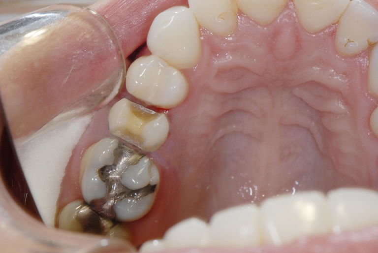 điều trị sâu răng hàm