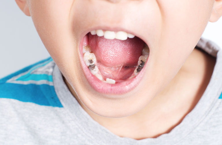 Số bệnh về răng miệng