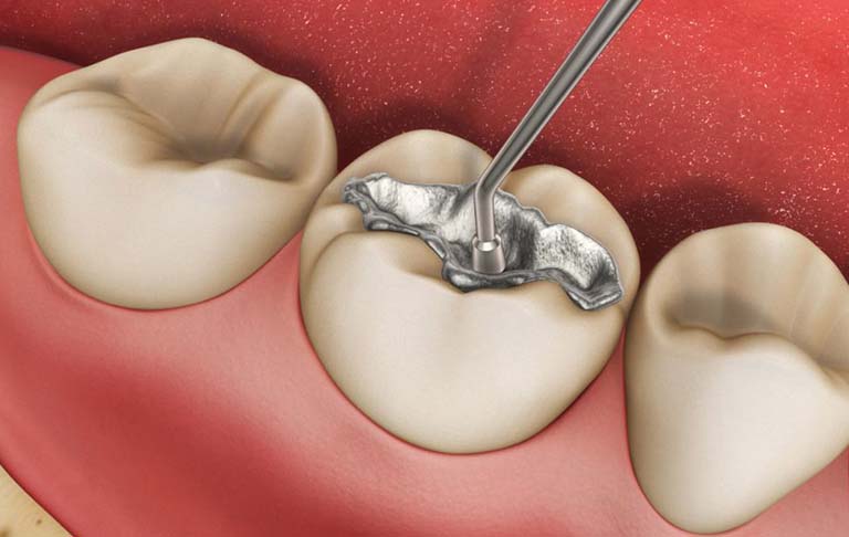 Trám răng là phương pháp sử dụng các vật liệu y tế để phủ lên các vị trí răng bị sâu