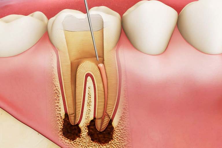 Chữa răng sâu bằng cách nào cho hiệu quả