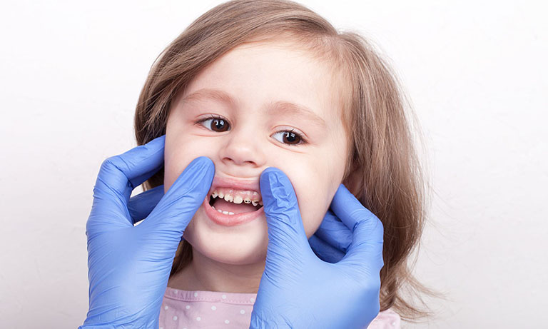 sâu răng ở trẻ em
