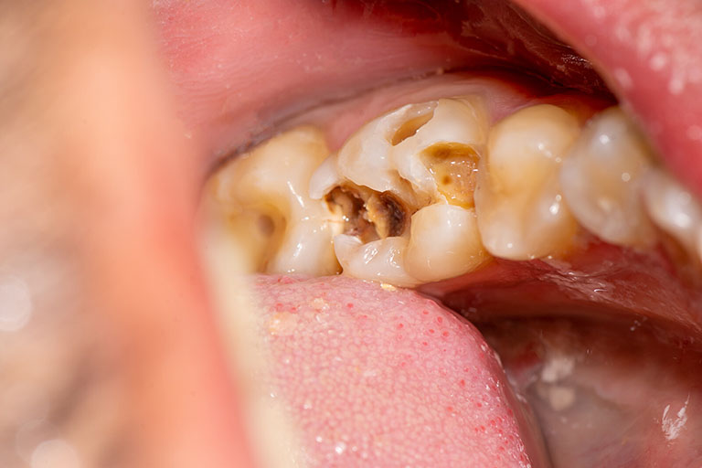 bệnh sâu răng ở trẻ em