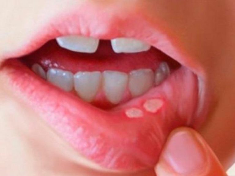 Nhiệt miệng không chỉ là căn bệnh thường gặp ở người lớn mà còn xuất hiện ở trẻ nhỏ