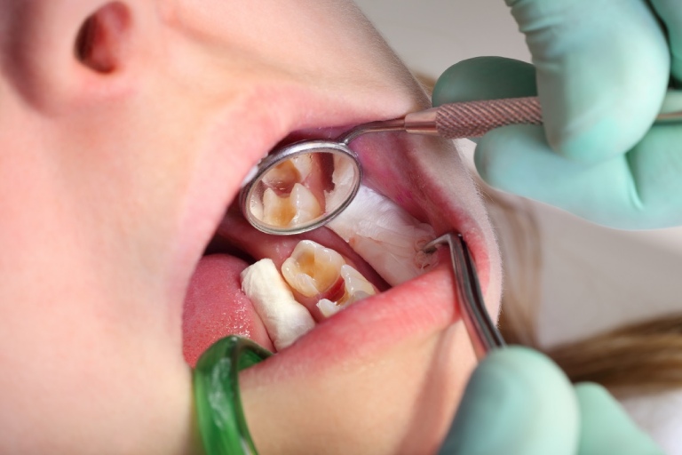 điều trị sâu răng vào tủy ở trẻ