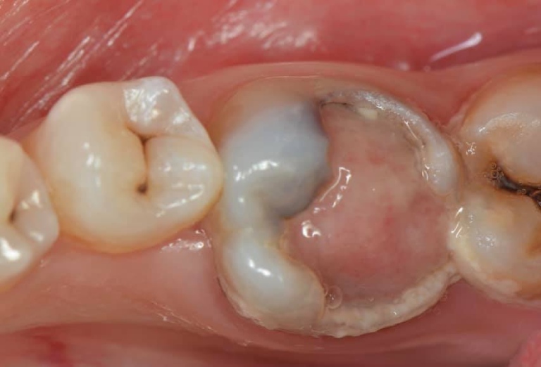 biến chứng sâu răng vào tủy ở trẻ