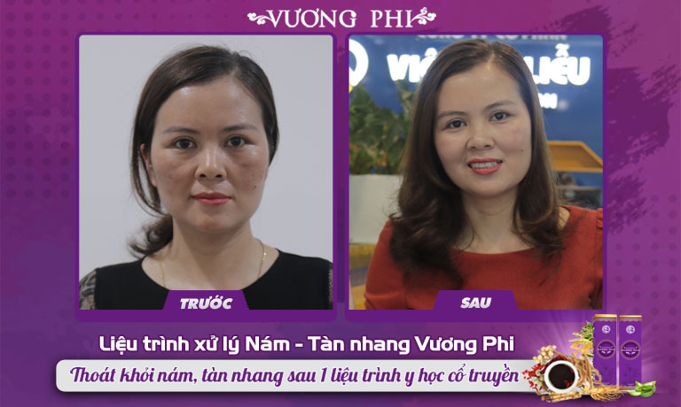 Khách hàng Nguyễn Thị Mơ khắc phục nám sạm nhờ Vương Phi