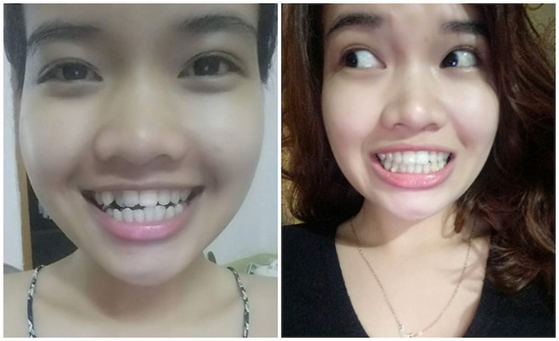 Chị Trang rất hài lòng sau khi niềng răng tại Vidental.