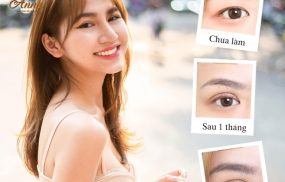 cắt mí tại Thẩm mỹ Quốc tế Anna