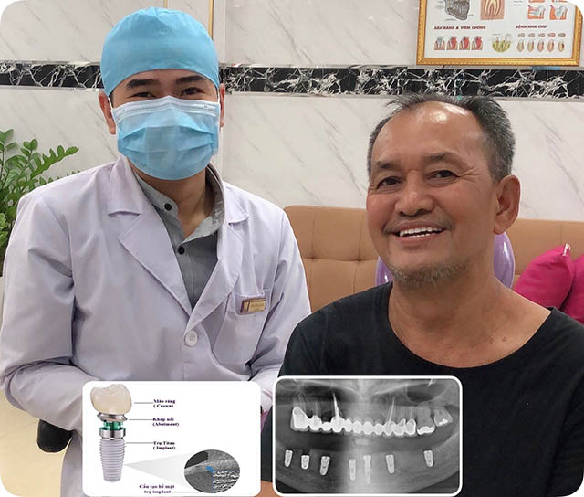 Nha khoa sunny trồng răng implant 