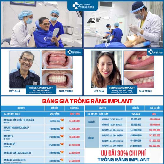 Bảng giá trồng răng implant tphcm uy tín nhất Sài Gòn nha khoa 
