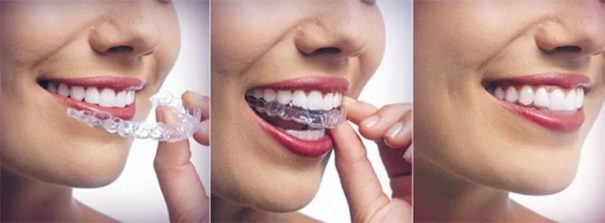 địa chỉ niềng răng trong suốt tại TPHCM